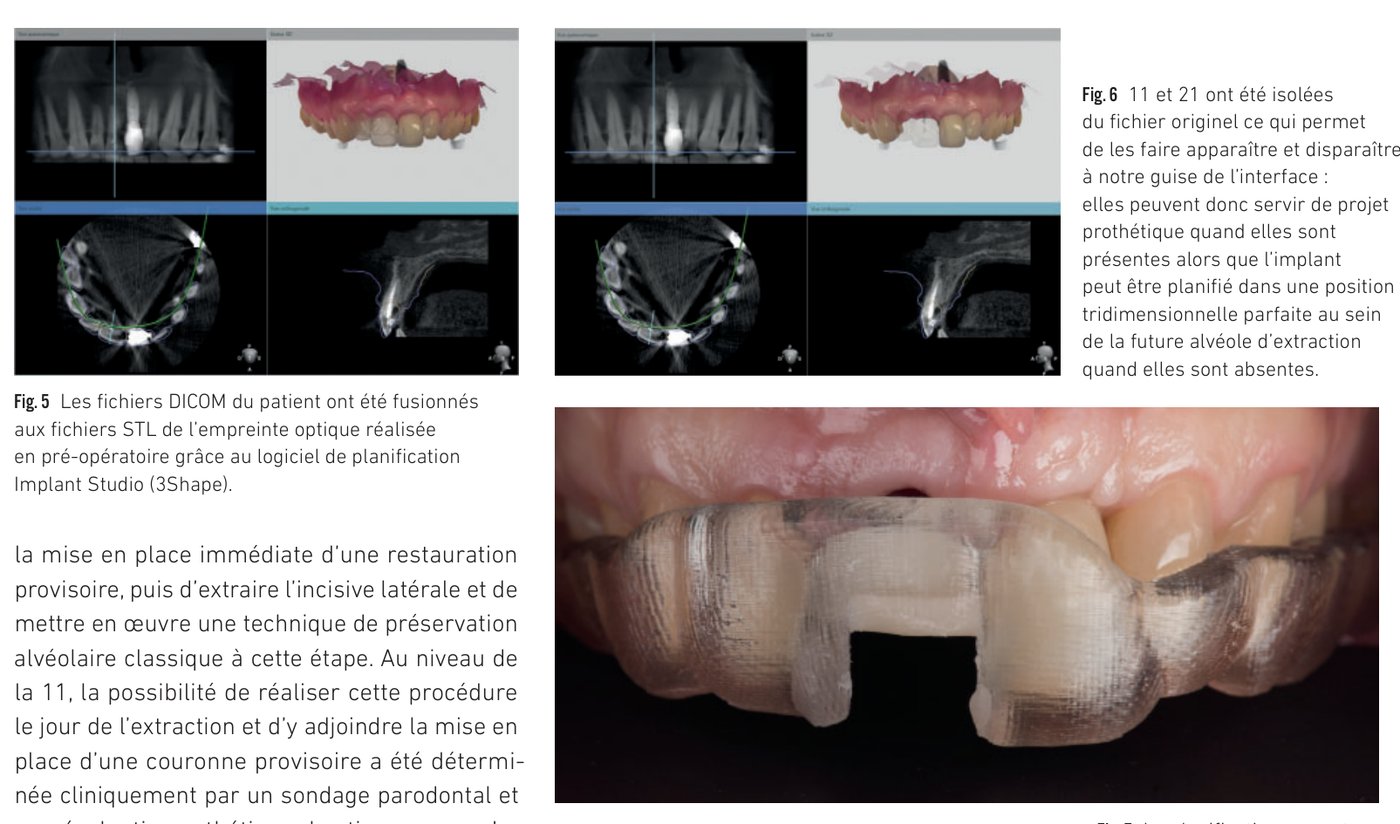 Fig. 5 à 7 — Planification implantaire numérique et guide chirurgical stéréolithographique