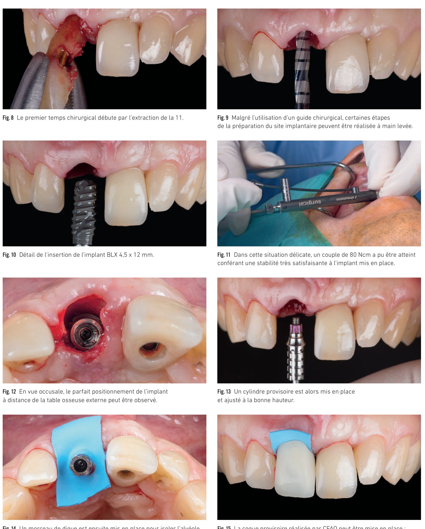 Fig. 8 à 15 — Extraction, forage guidé, insertion du BLX à 80 Ncm, et mise en place de la coque provisoire