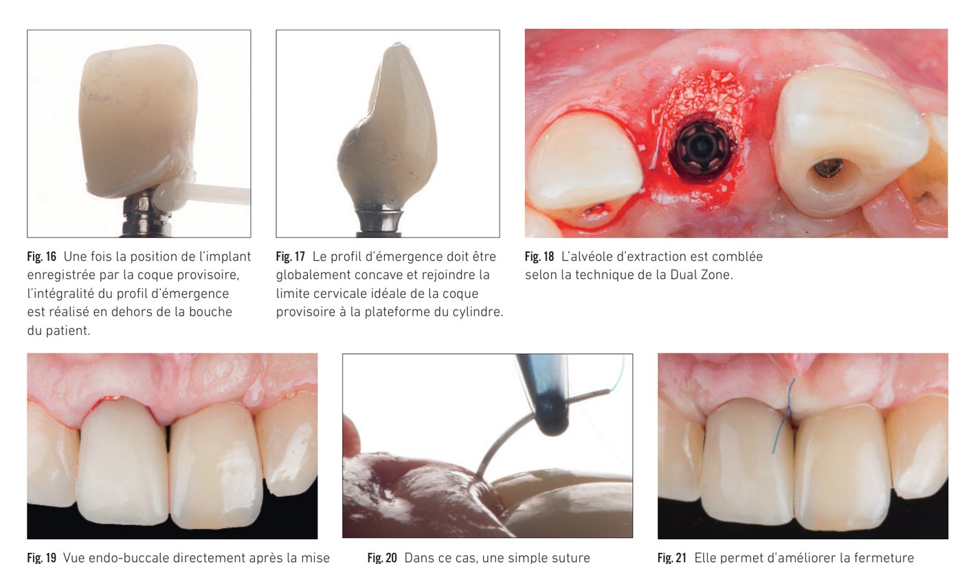 Fig. 16 à 21 — Profil d'émergence, comblement Dual Zone et mise en place de la provisoire