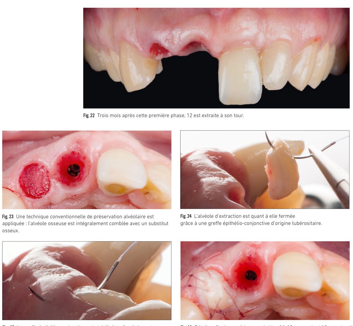 Fig. 22 à 26 — Extraction de 12, préservation alvéolaire et bridge provisoire en extension