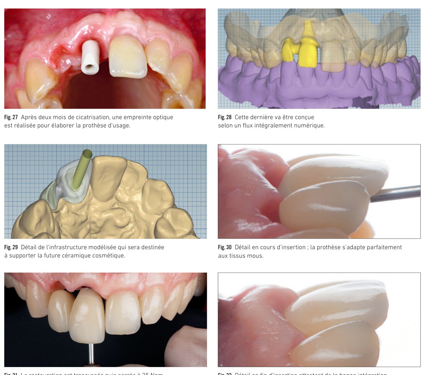 Fig. 27 à 32 — Empreinte optique, modélisation numérique et insertion de la prothèse d'usage