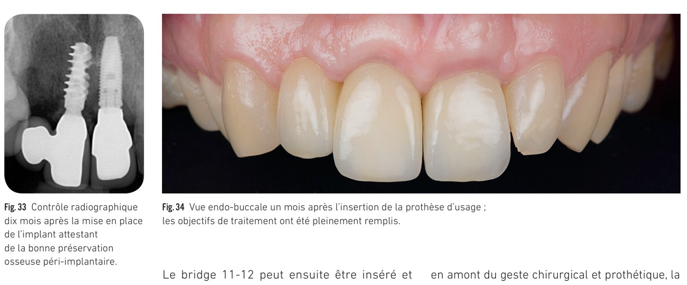 Fig. 33-34 — Contrôle radiographique et vue endo-buccale finale un mois après l'insertion