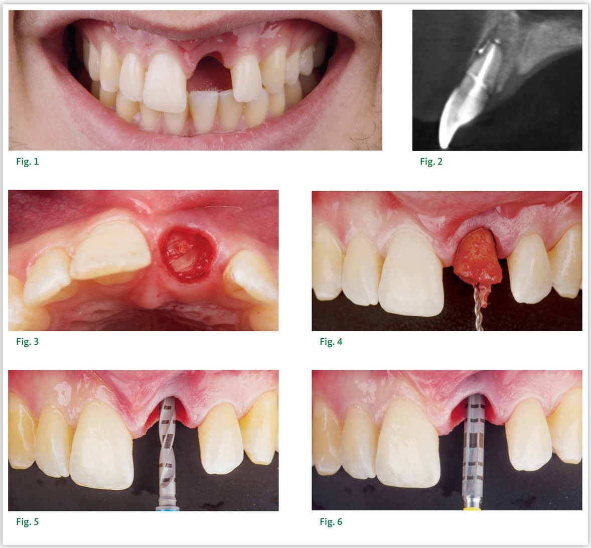 Séquence chirurgicale — extraction atraumatique, forage et mise en place de l'implant BLT