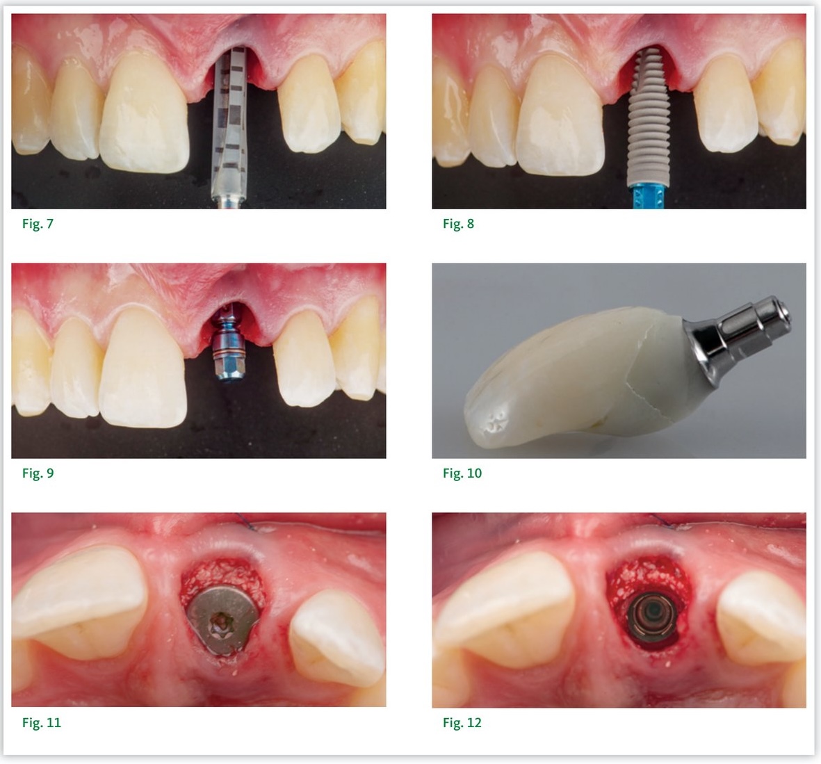 Solidarisation de la couronne provisoire, comblement à la xénogreffe et résultat postopératoire