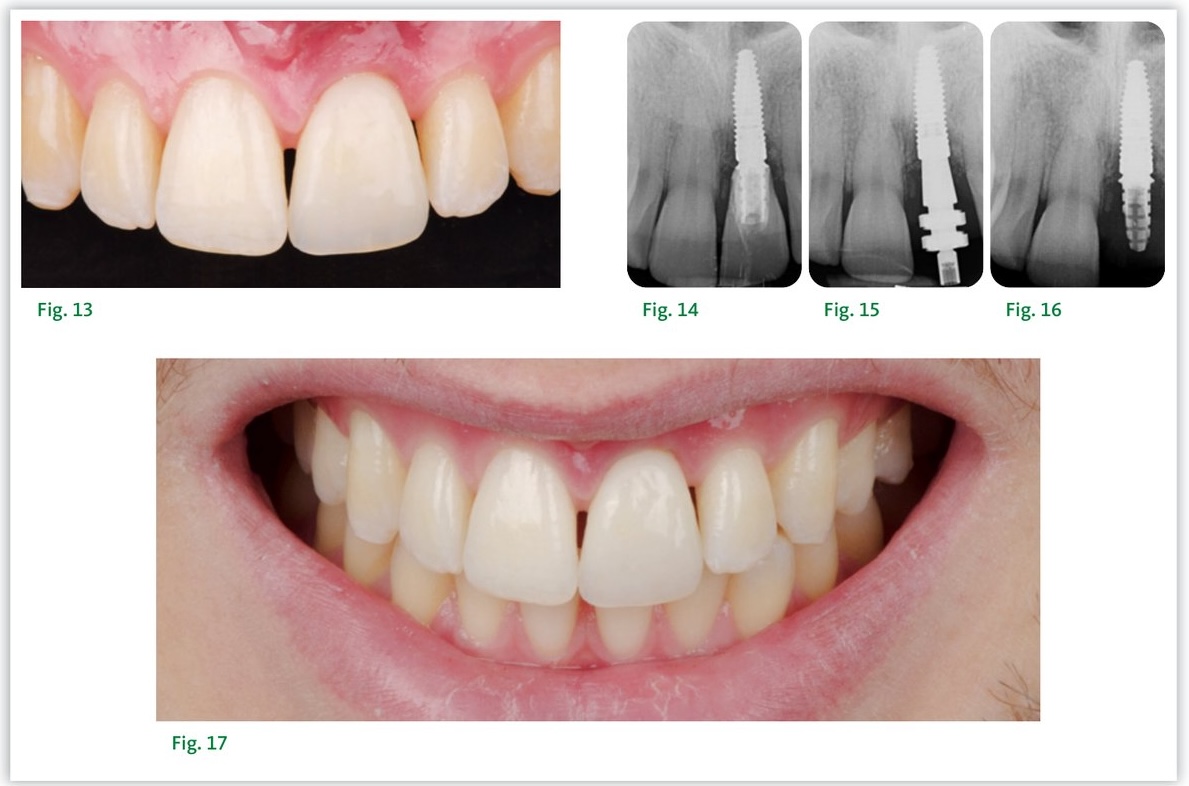 Résultat à 3 mois — restauration implantaire définitive en secteur antérieur
