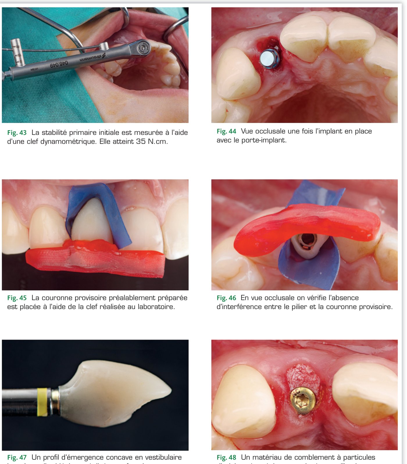 Cas clinique 1 — Stabilité primaire, couronne provisoire et comblement (Fig. 43 à 48)