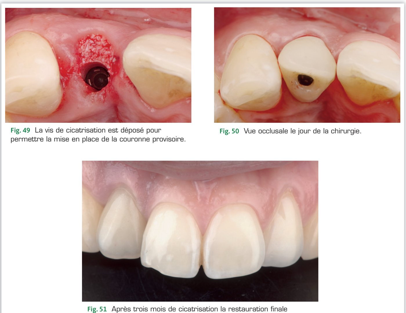 Cas clinique 1 — Mise en place de la provisoire et restauration finale à 3 mois (Fig. 49 à 51)