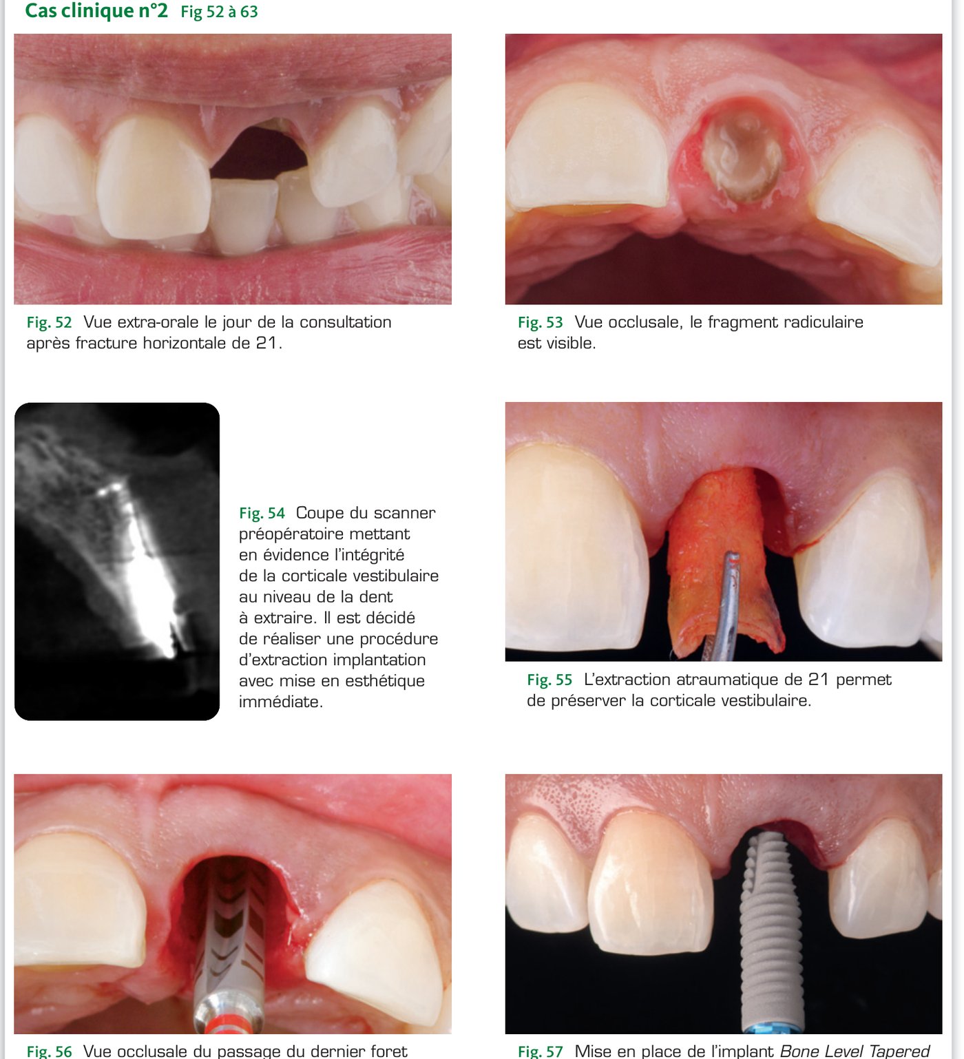 Cas clinique 2 — Fracture de 21, extraction, mise en place du BLT 4,1 × 12 mm (Fig. 52 à 57)