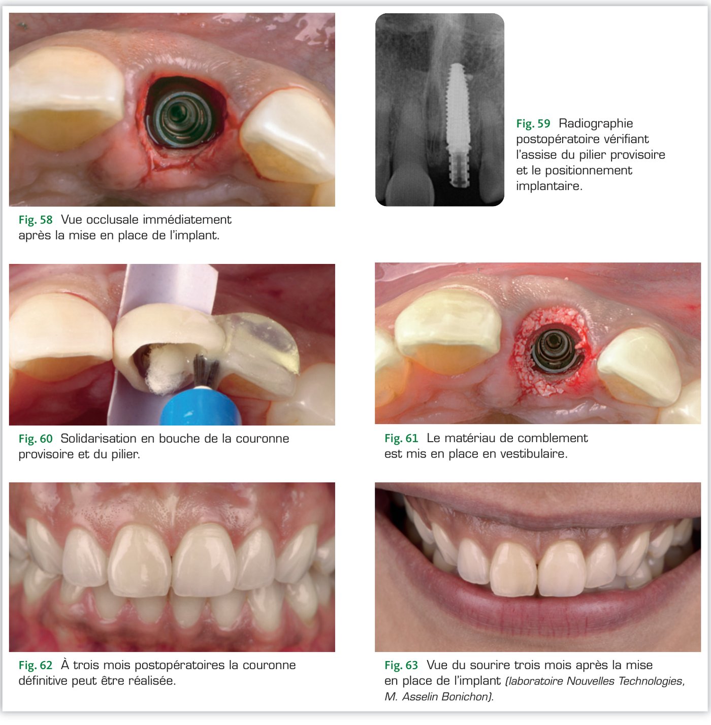 Cas clinique 2 — Comblement vestibulaire, couronne définitive et vue du sourire à 3 mois (Fig. 58 à 63)