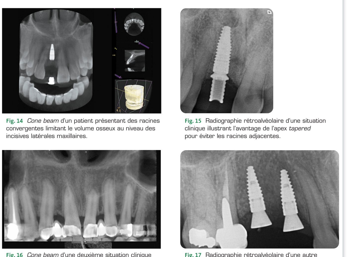Situation clinique 1 — Cone beam et radiographies illustrant la gestion des racines convergentes (Fig. 14 à 17)