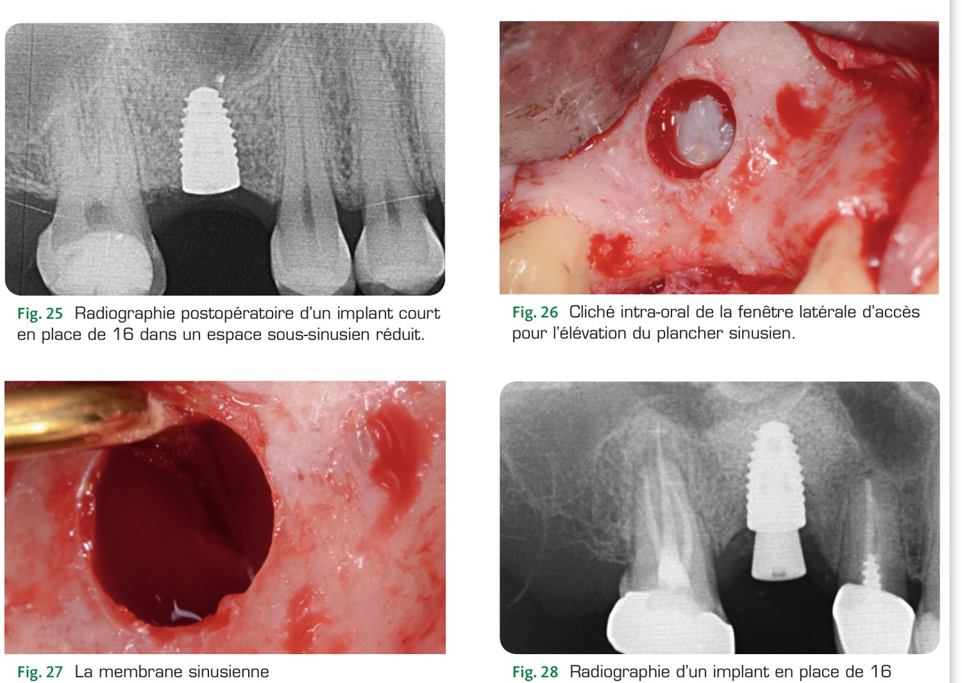 Situation clinique 3 — Implantation sous-sinusienne : implant court, élévation sinusienne (Fig. 25 à 28)