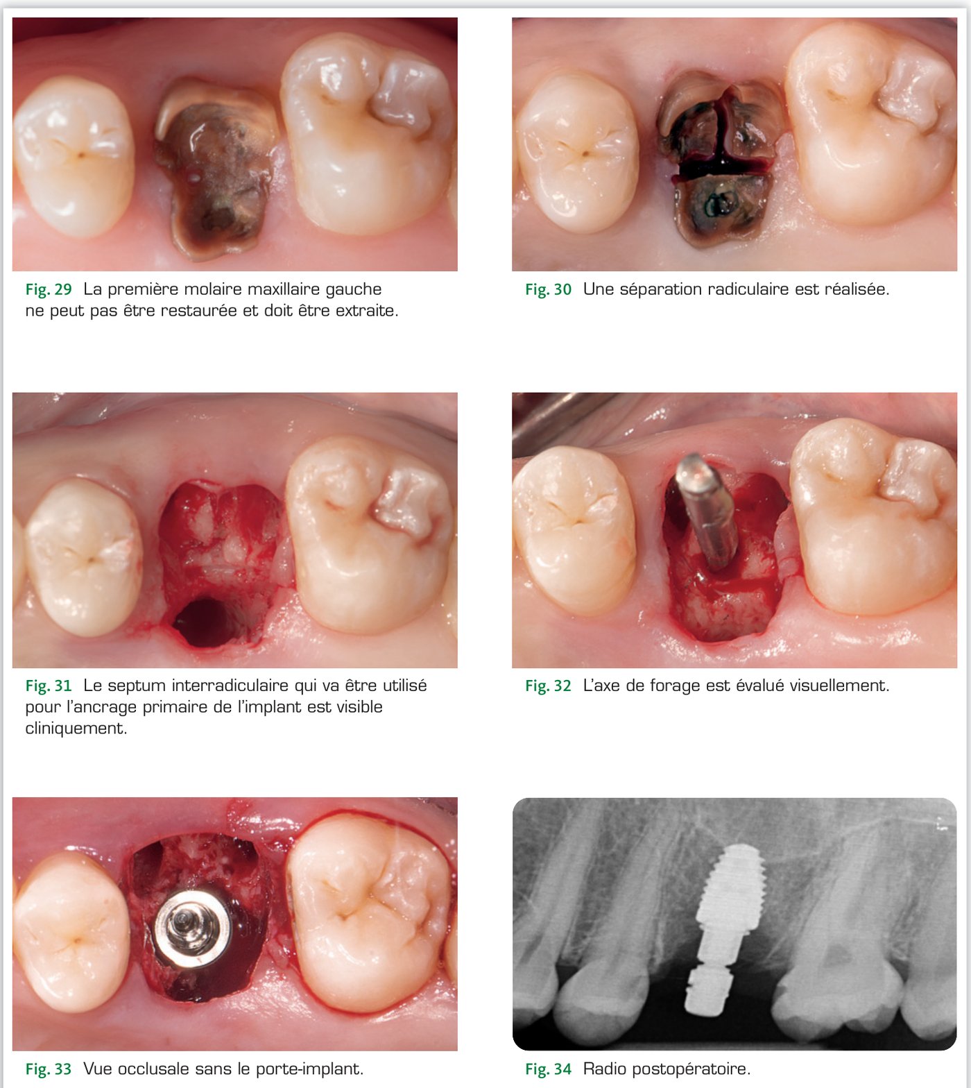 Situation clinique 3 — Extraction-implantation molaire avec ancrage sur septum (Fig. 29 à 34)