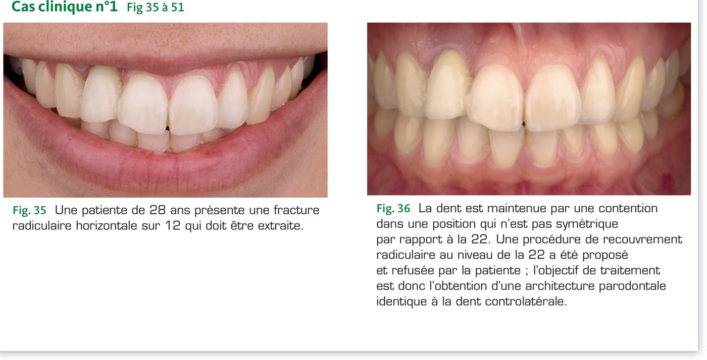 Cas clinique 1 — Vue initiale : fracture radiculaire sur 12 (Fig. 35-36)