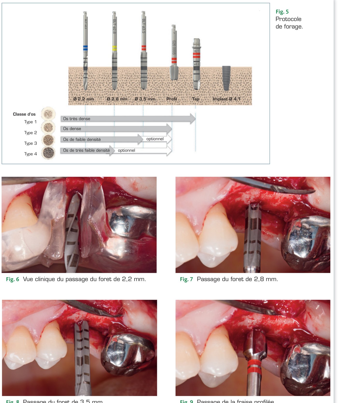 Fig. 5 à 9 — Protocole de forage selon le type d'os et vues cliniques