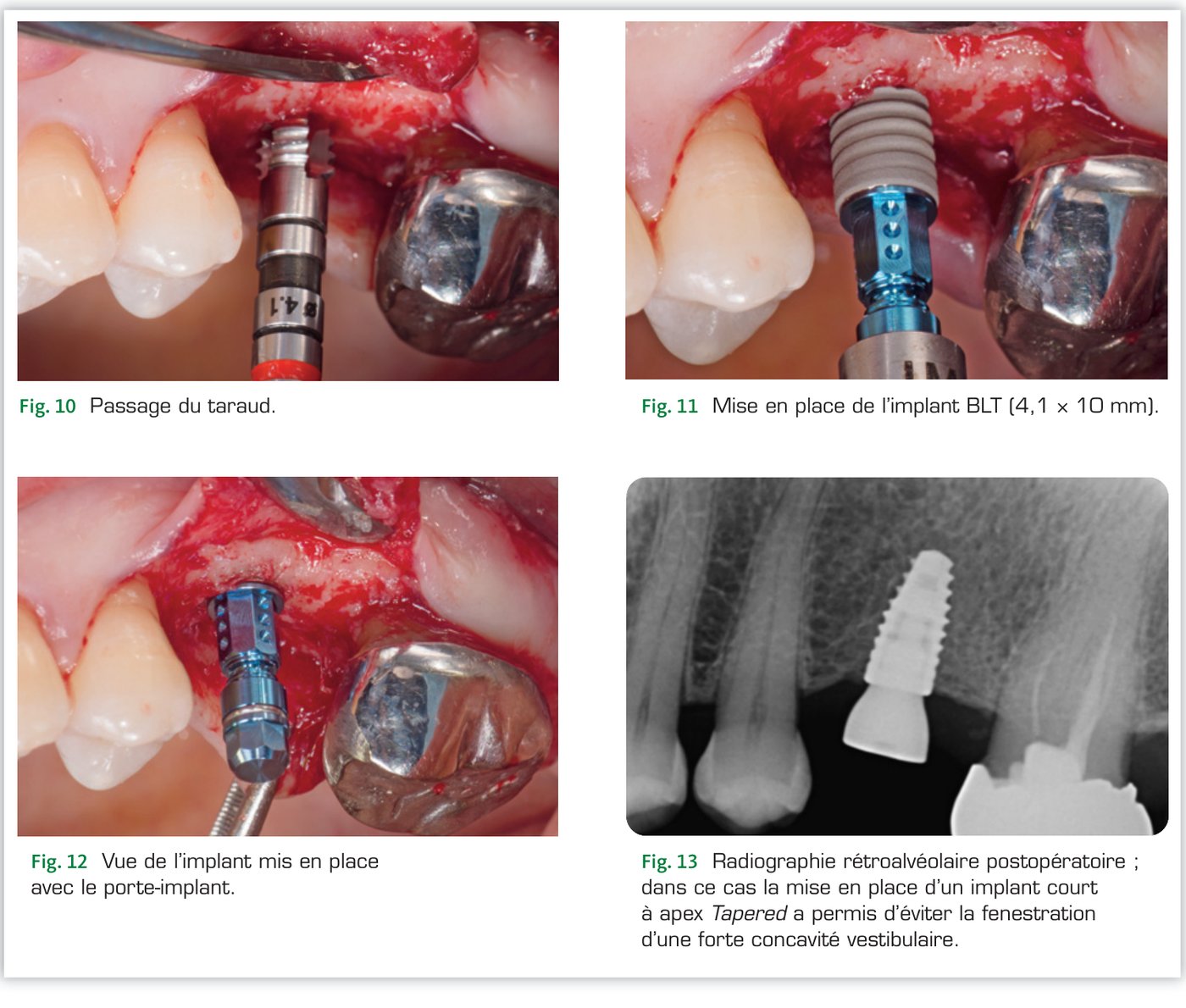 Fig. 10 à 13 — Mise en place de l'implant BLT et radiographie postopératoire