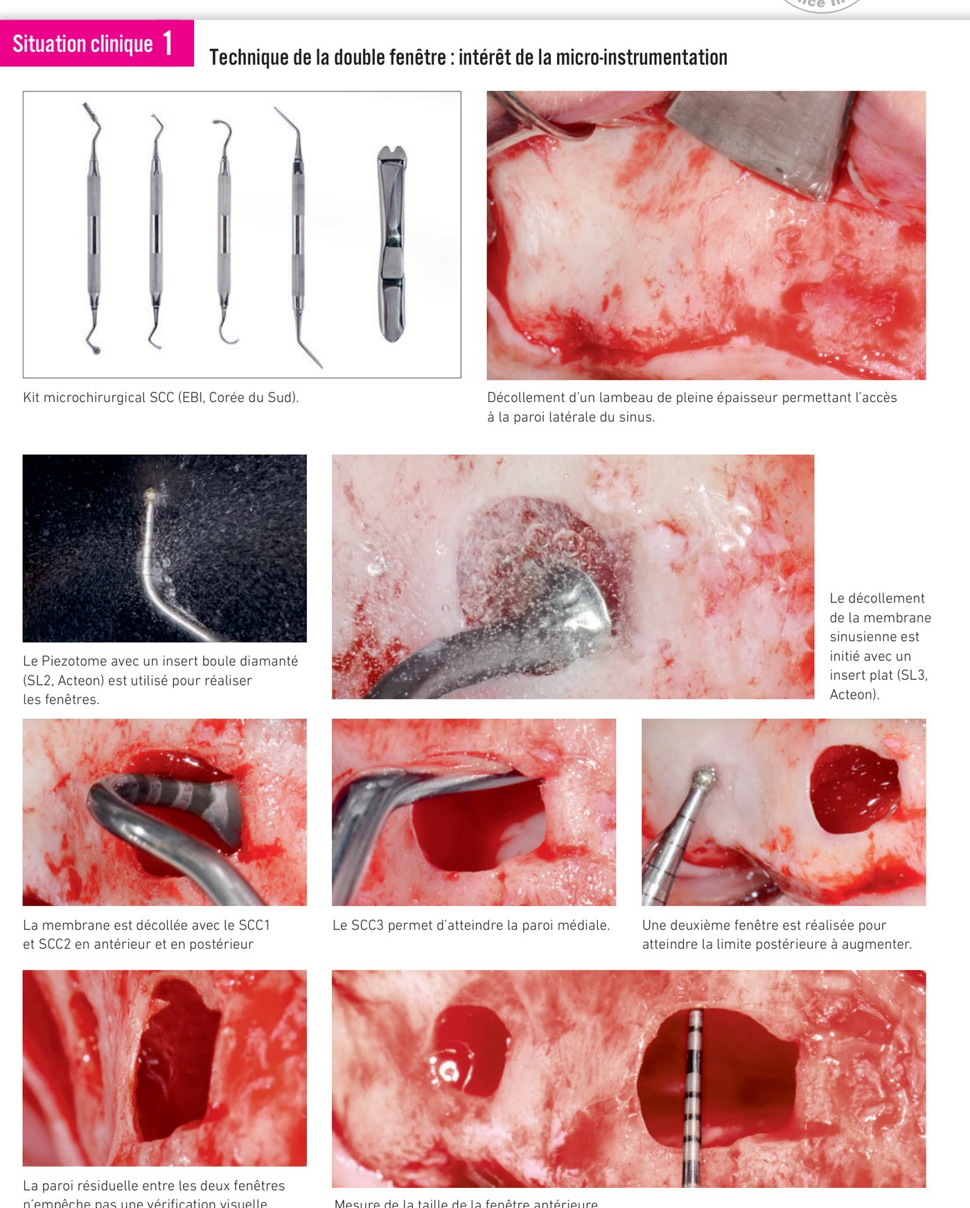 Situation clinique 1 — technique de la double fenêtre, micro-instrumentation et décollement de la membrane sinusienne
