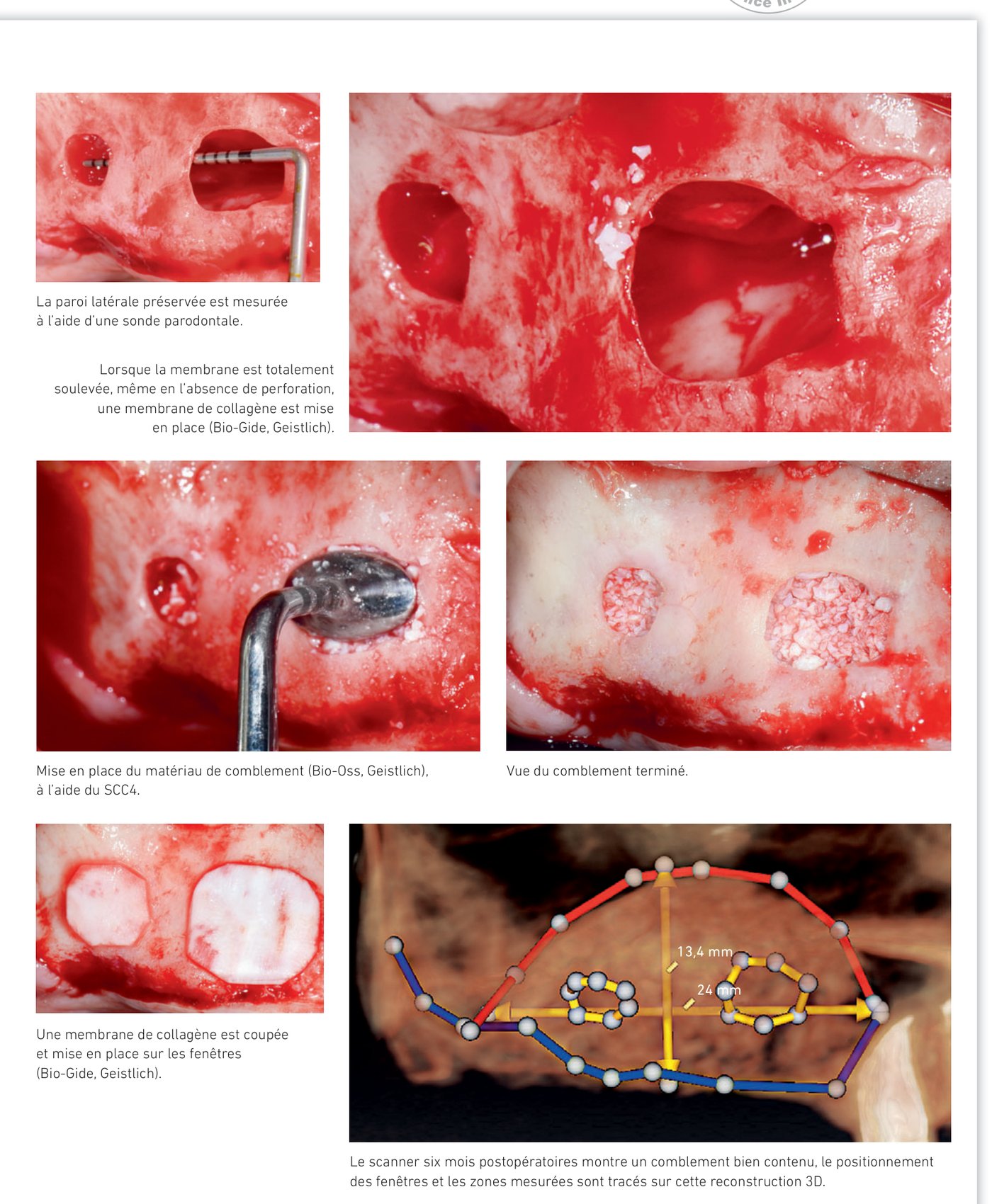 Suite situation clinique 1 — comblement au Bio-Oss, membrane de collagène et scanner postopératoire à 6 mois
