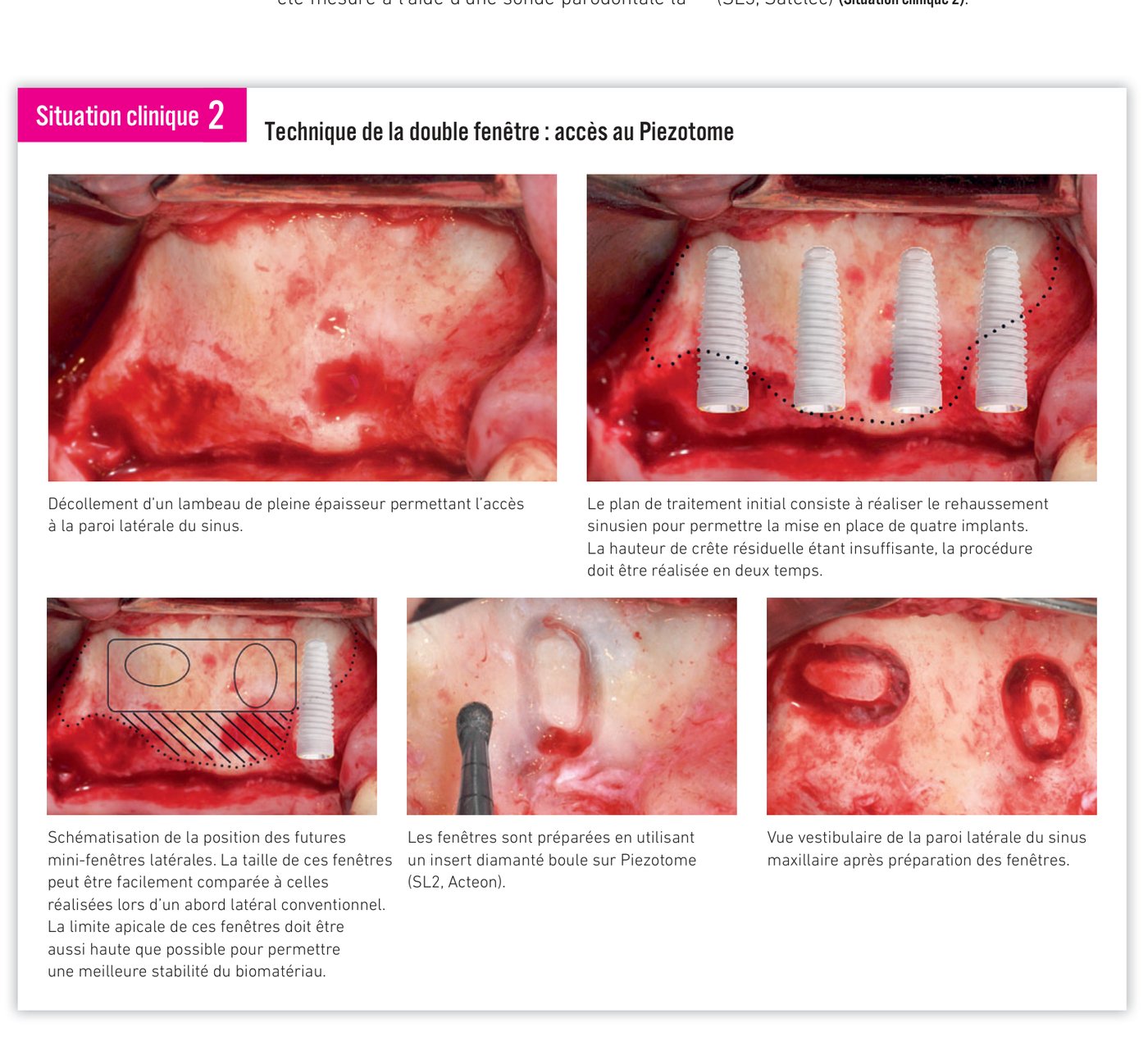 Schématisation de la position des mini-fenêtres et préparation au Piezotome