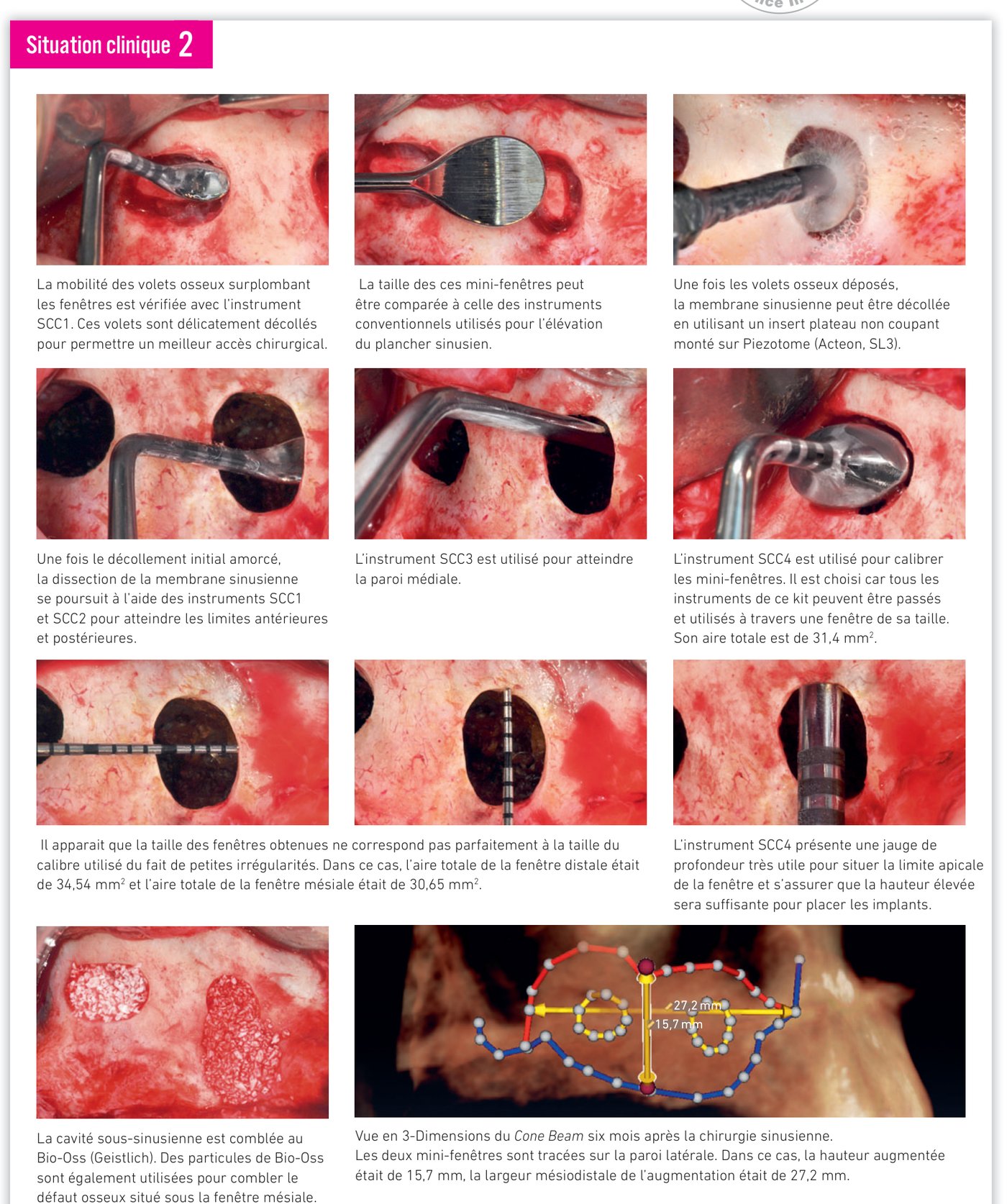 Situation clinique 2 — préparation des fenêtres, décollement membranaire, comblement et scanner 3D postopératoire
