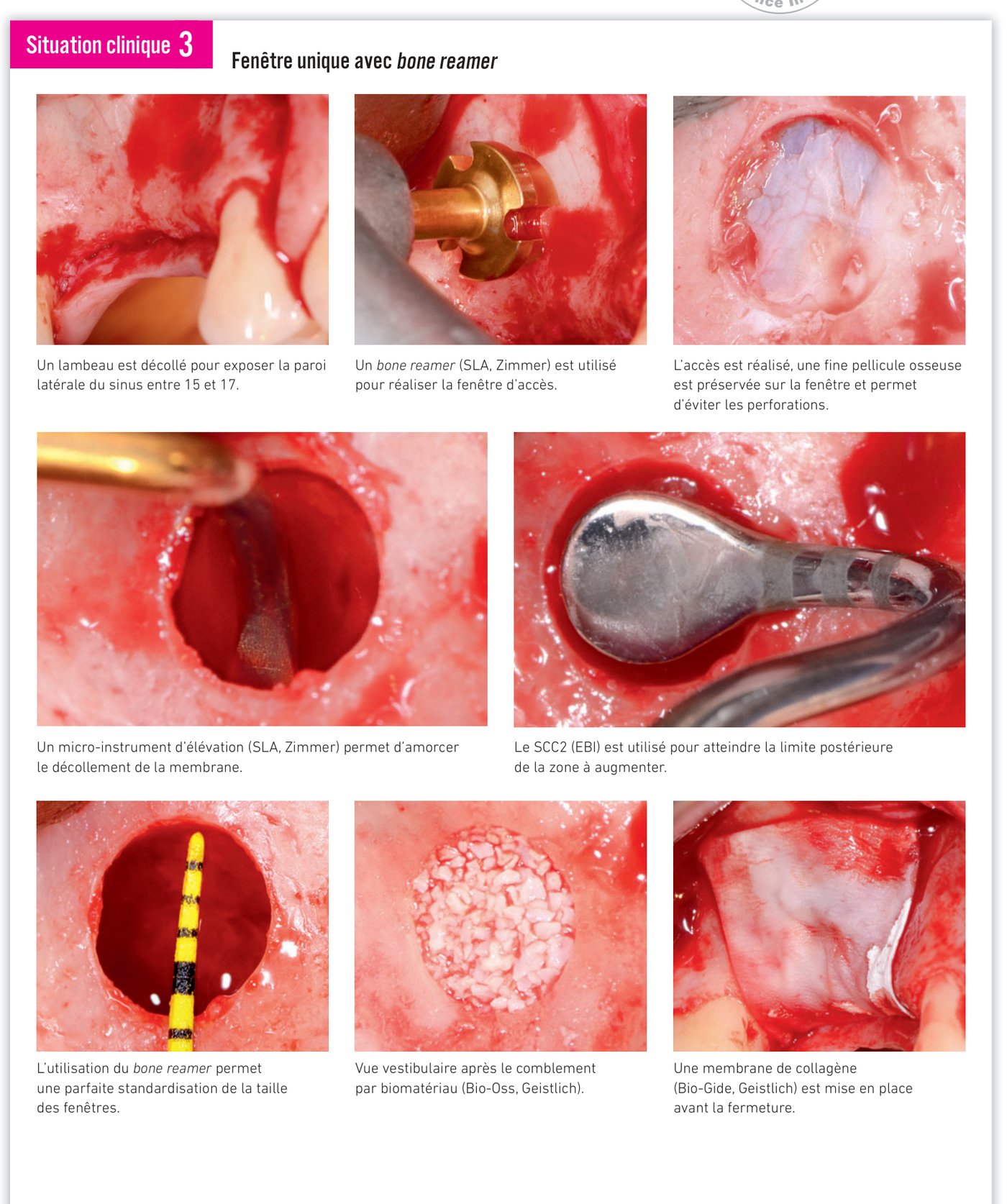 Situation clinique 3 — utilisation du bone reamer pour l'accès latéral et comblement sinusien