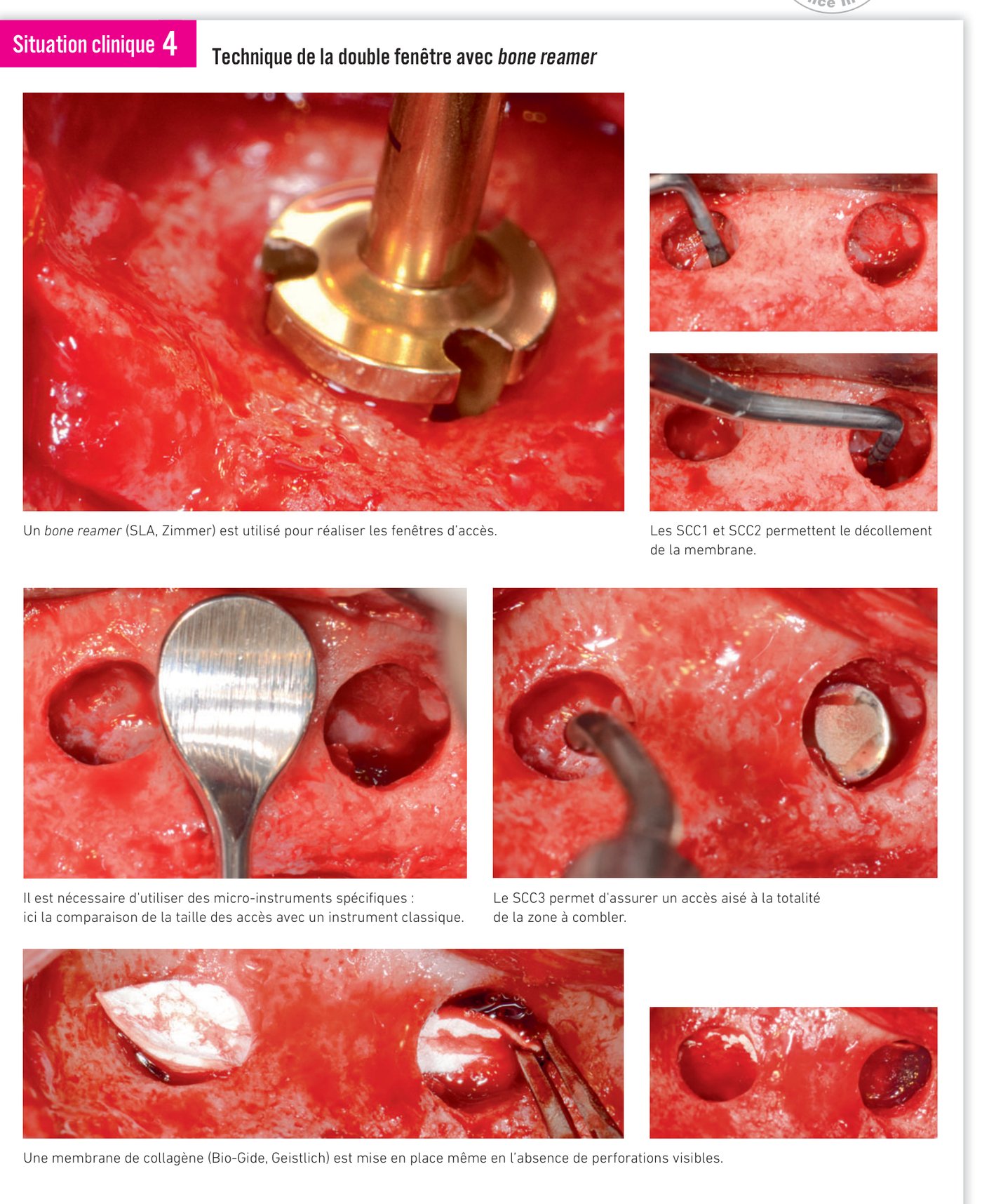 Situation clinique 4 — gestion d'une perforation membranaire avec membrane de collagène