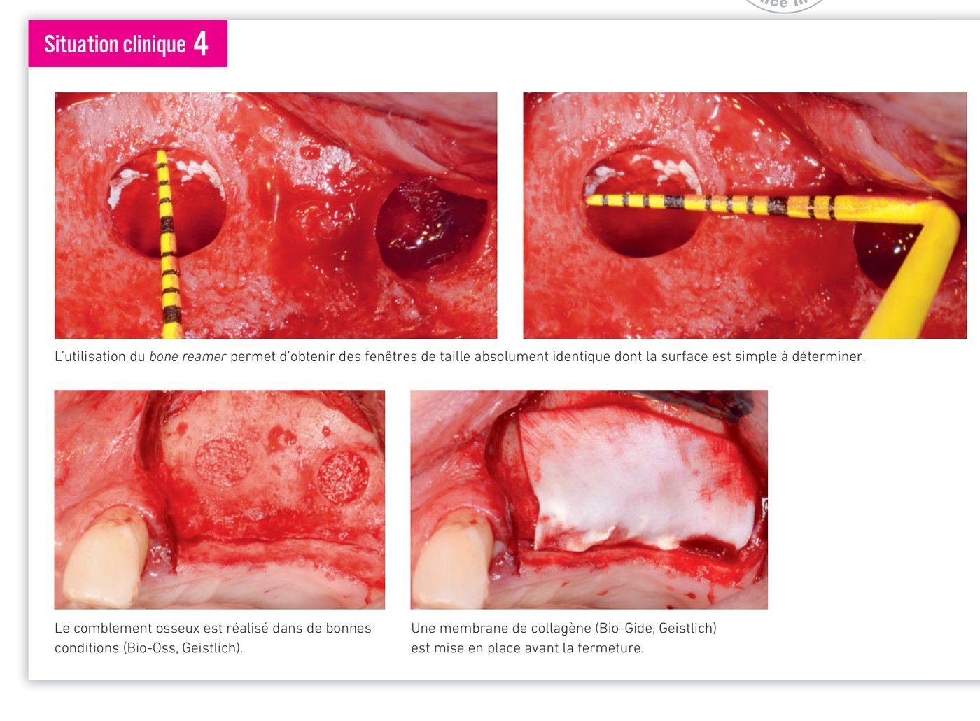 Suite situation clinique 4 — réparation de la perforation et comblement sinusien