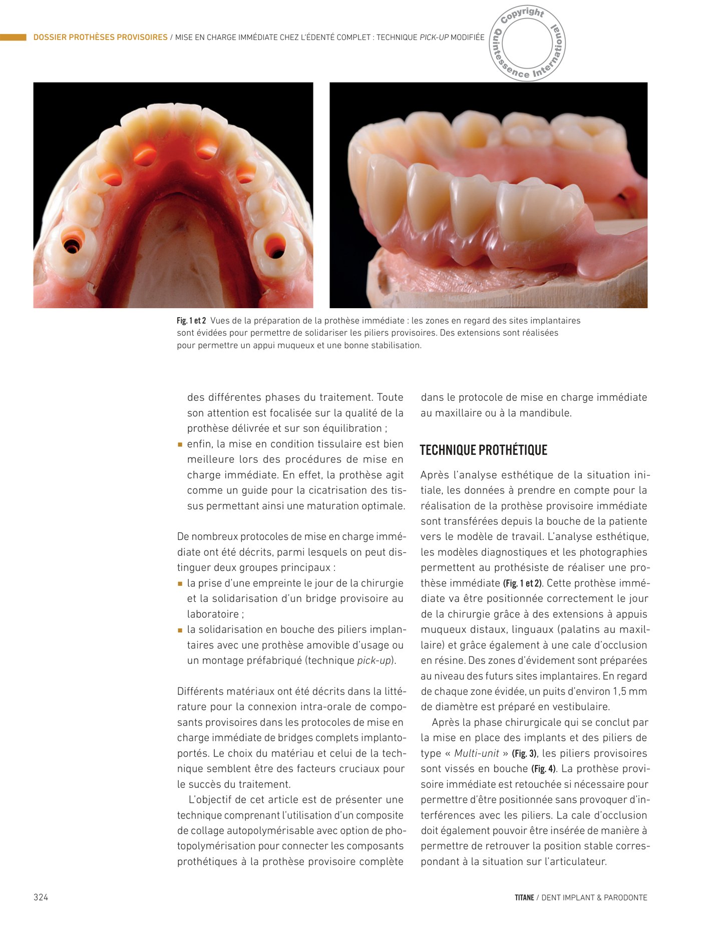 Protocole chirurgical — implants, piliers multi-units et mise en place de la prothèse immédiate