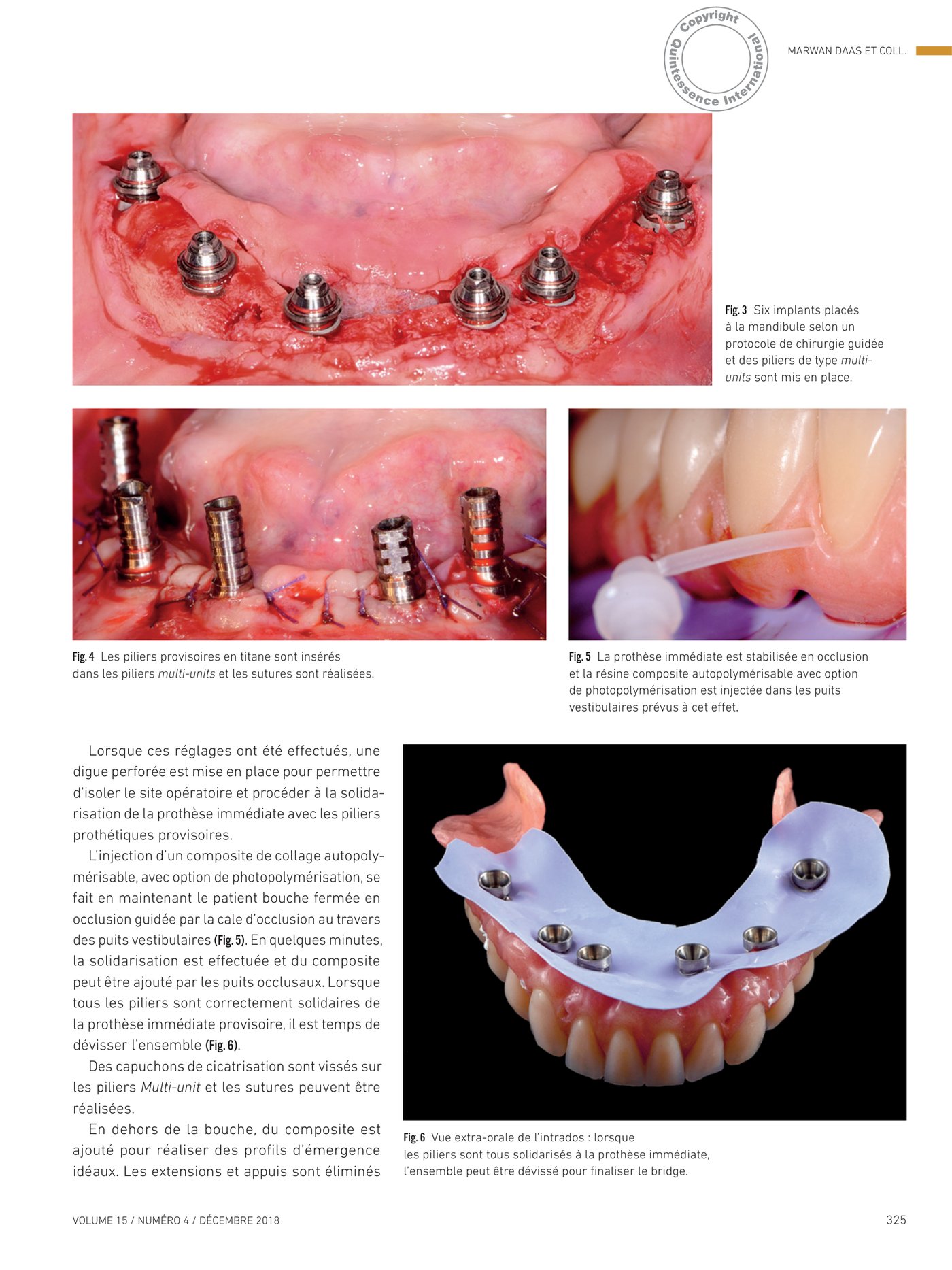 Solidarisation intra-orale au composite — dévissage et finitions extra-orales du bridge provisoire