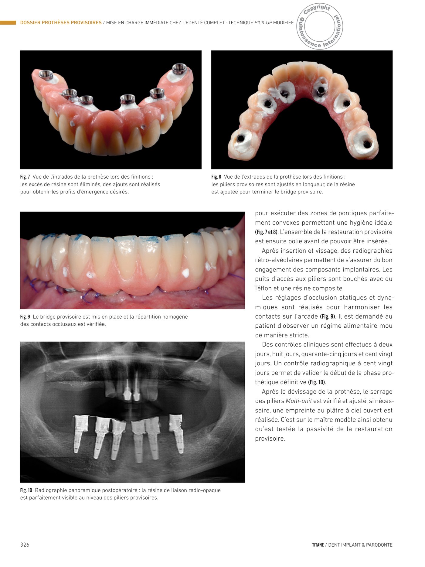 Finitions du bridge provisoire — profils d'émergence, contrôle occlusal et radiographie panoramique