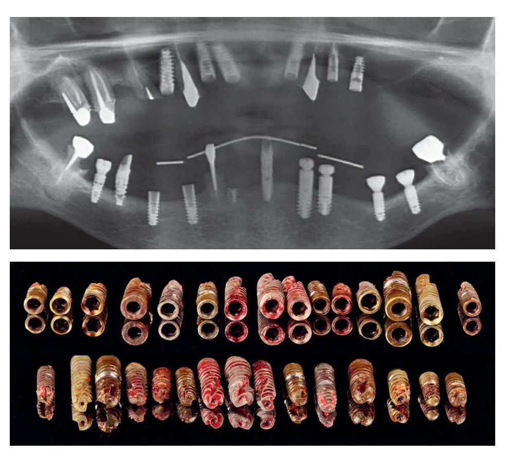 Observation clinique et facteurs de risque chez le futur édenté total
