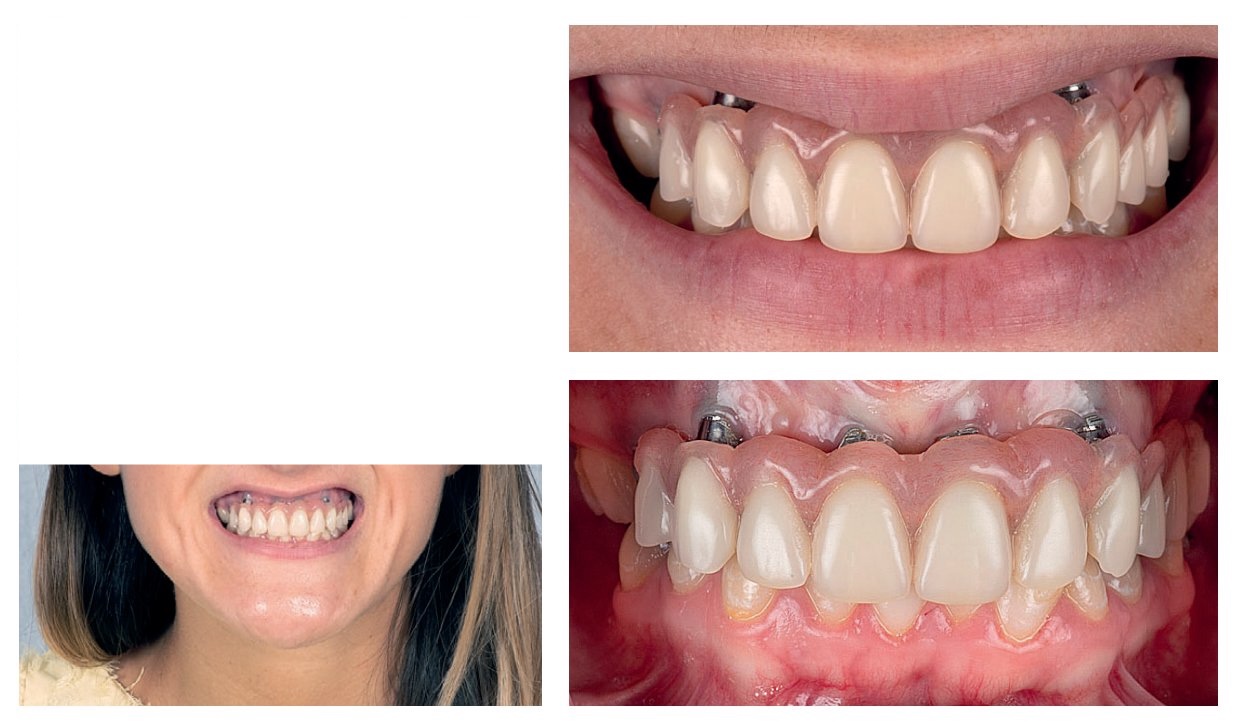 Observation clinique du futur édenté total et identification des facteurs de risque