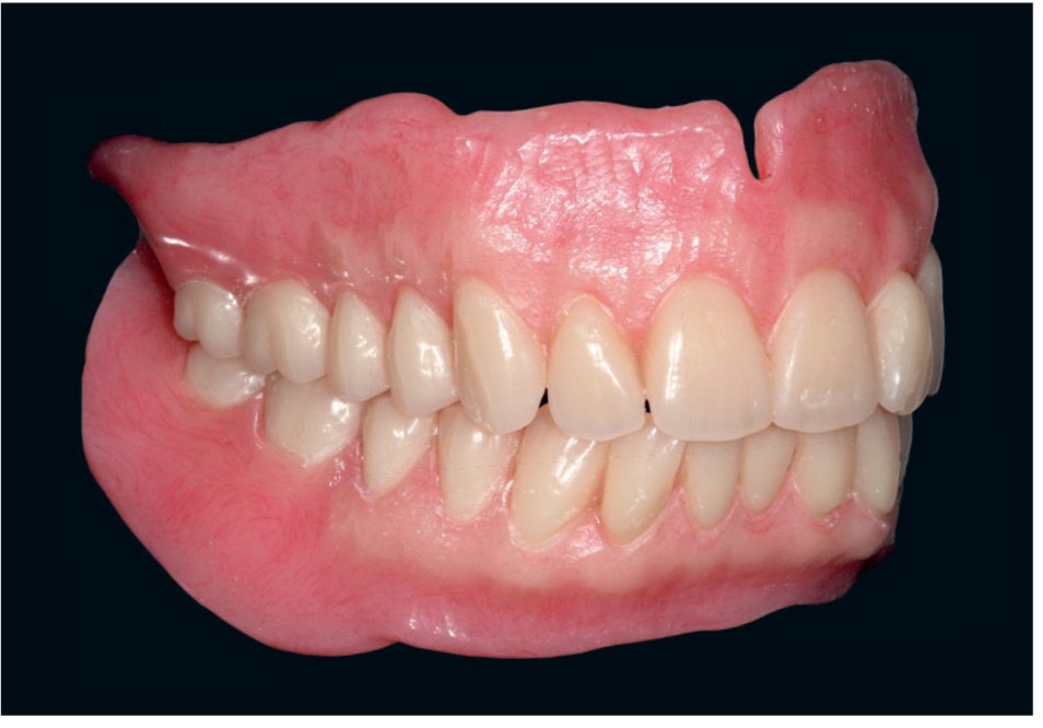 Réalisation d'une prothèse complète répondant à des critères de qualité