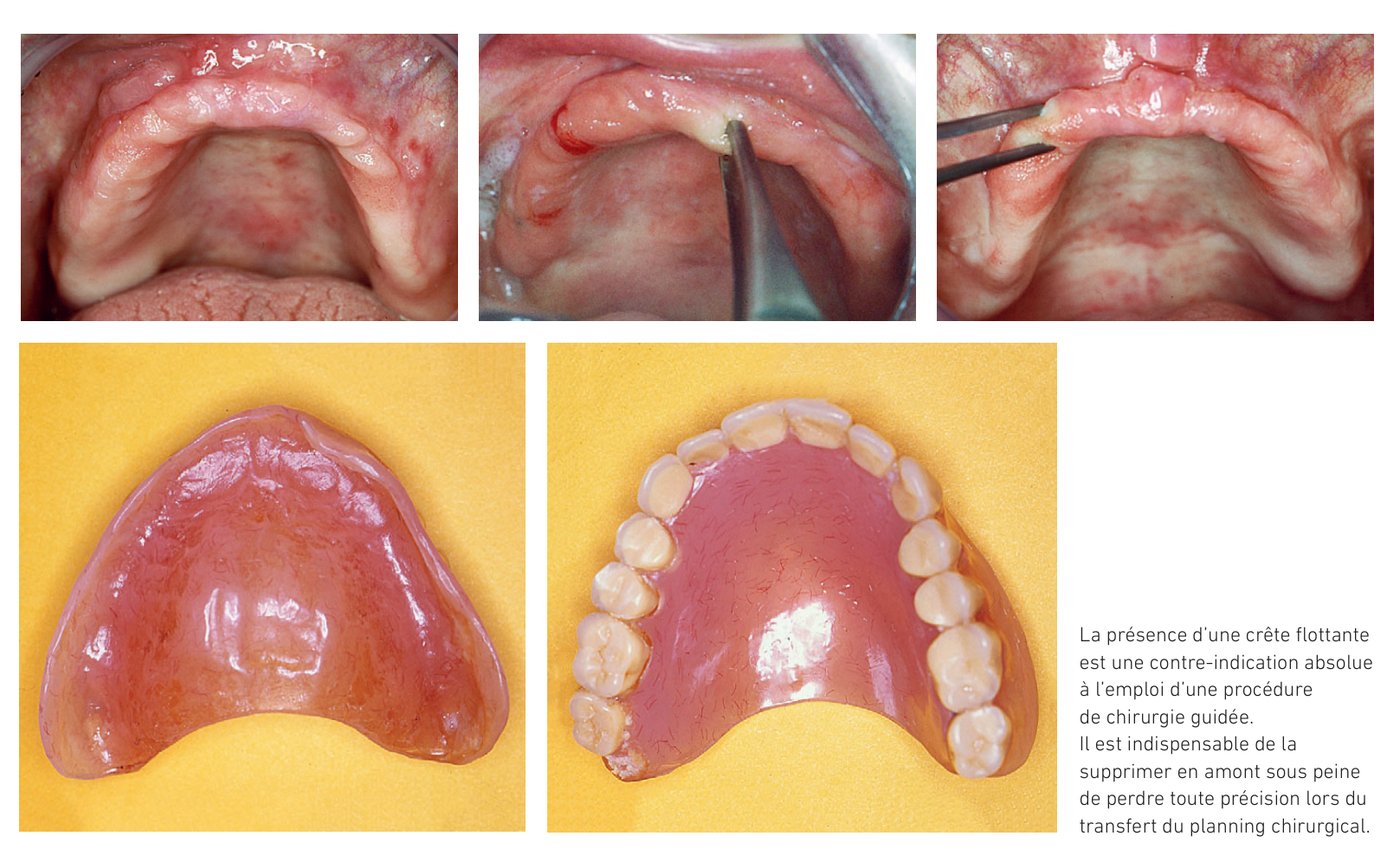 Validation du montage et élimination de la crête flottante