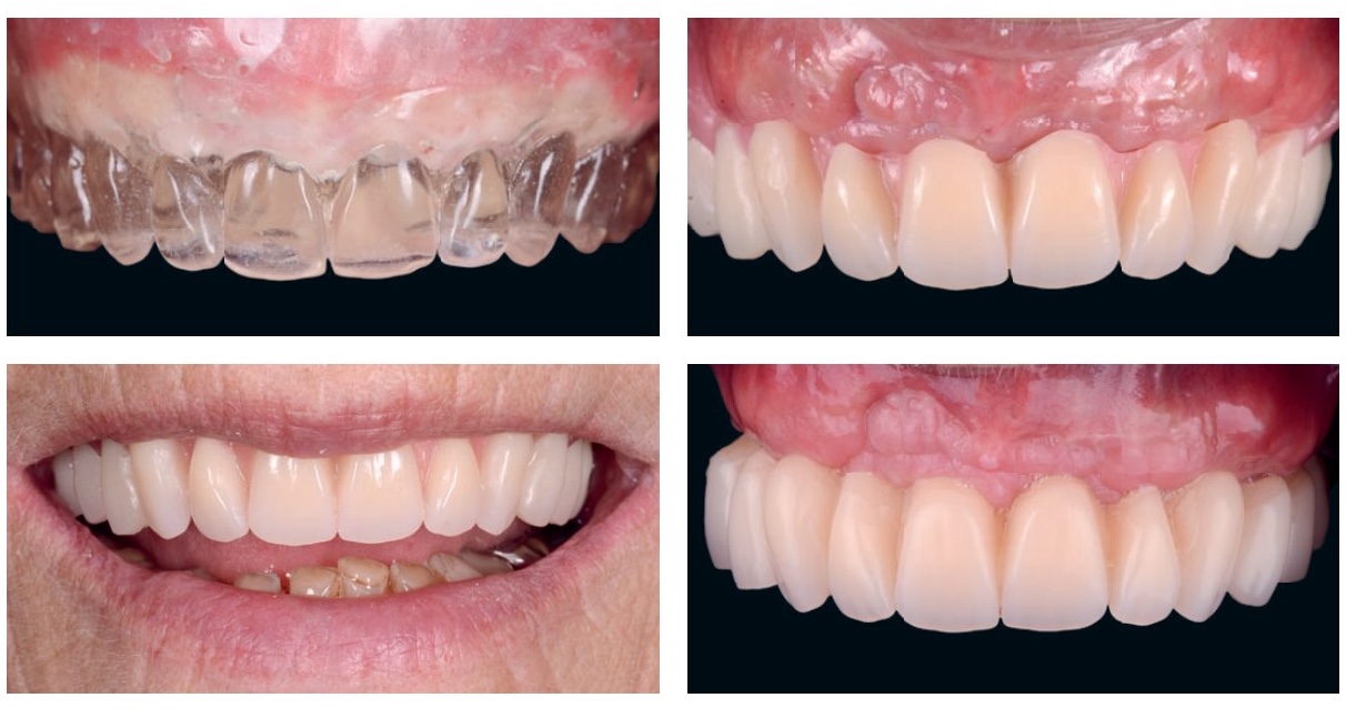 Positionnement du futur point interincisif et validation du montage