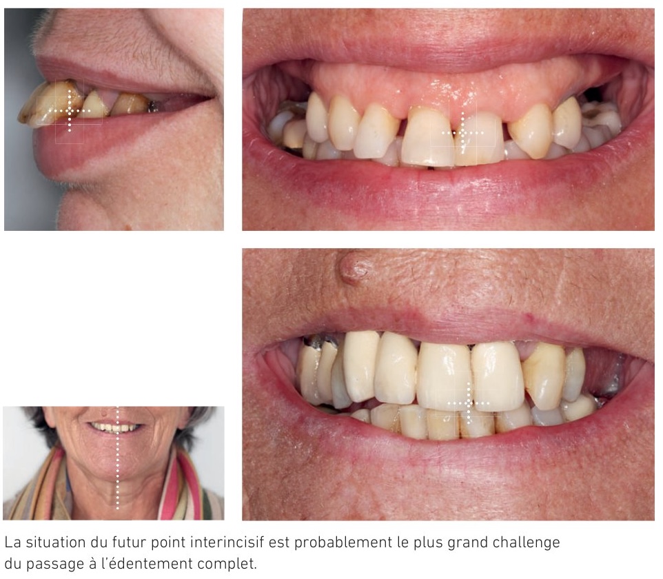 Matérialisation du rapport crête-dents grâce à un duplicata transparent
