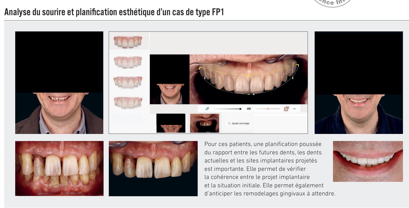 Analyse du sourire et planification esthétique d'un cas de type FP1