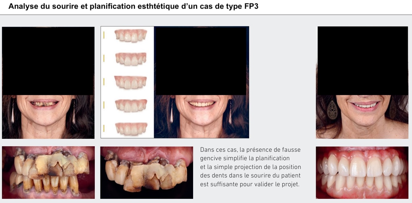 Analyse du sourire et planification esthétique d'un cas de type FP3