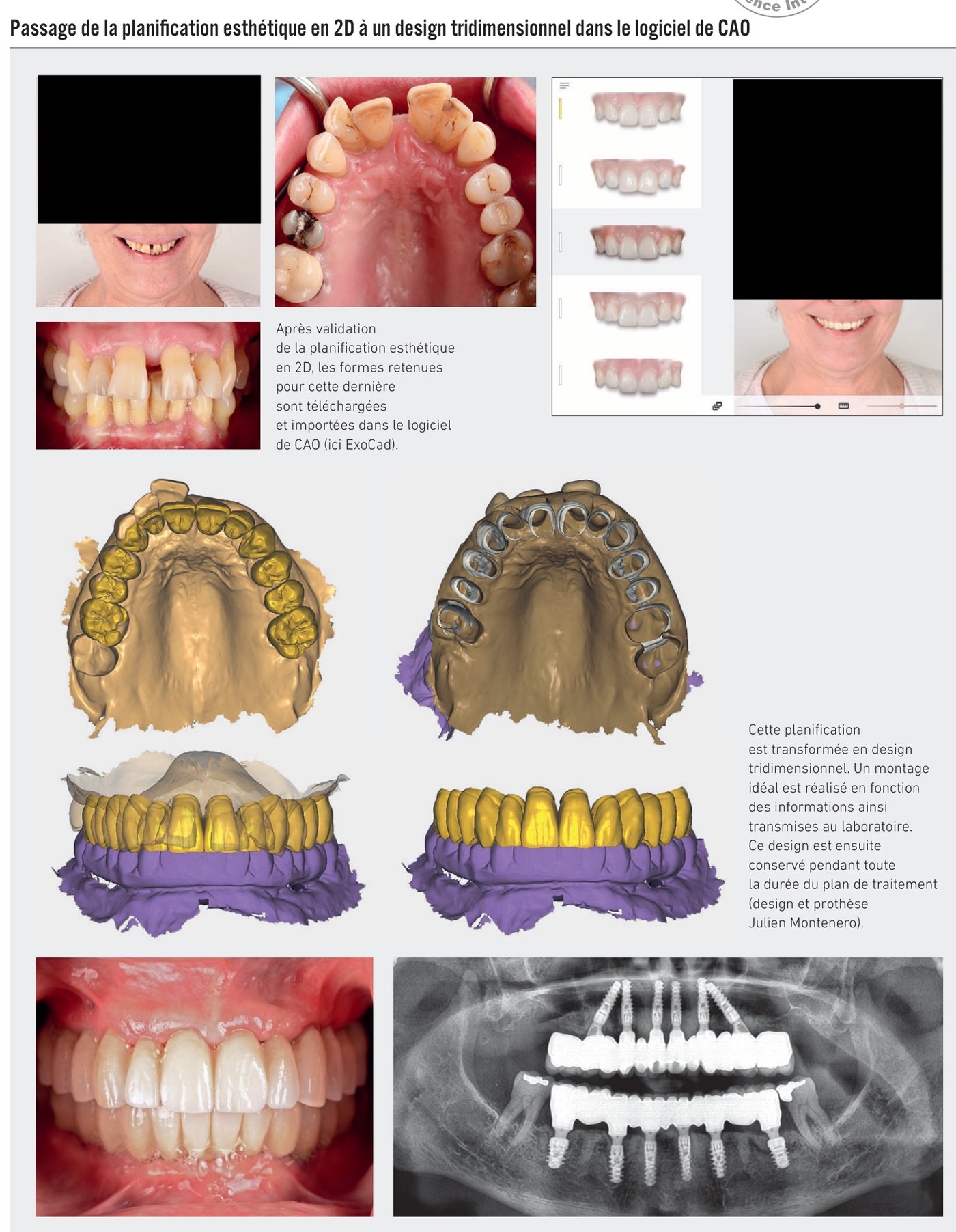 Passage de la planification esthétique en 2D à un design tridimensionnel dans le logiciel de CAO