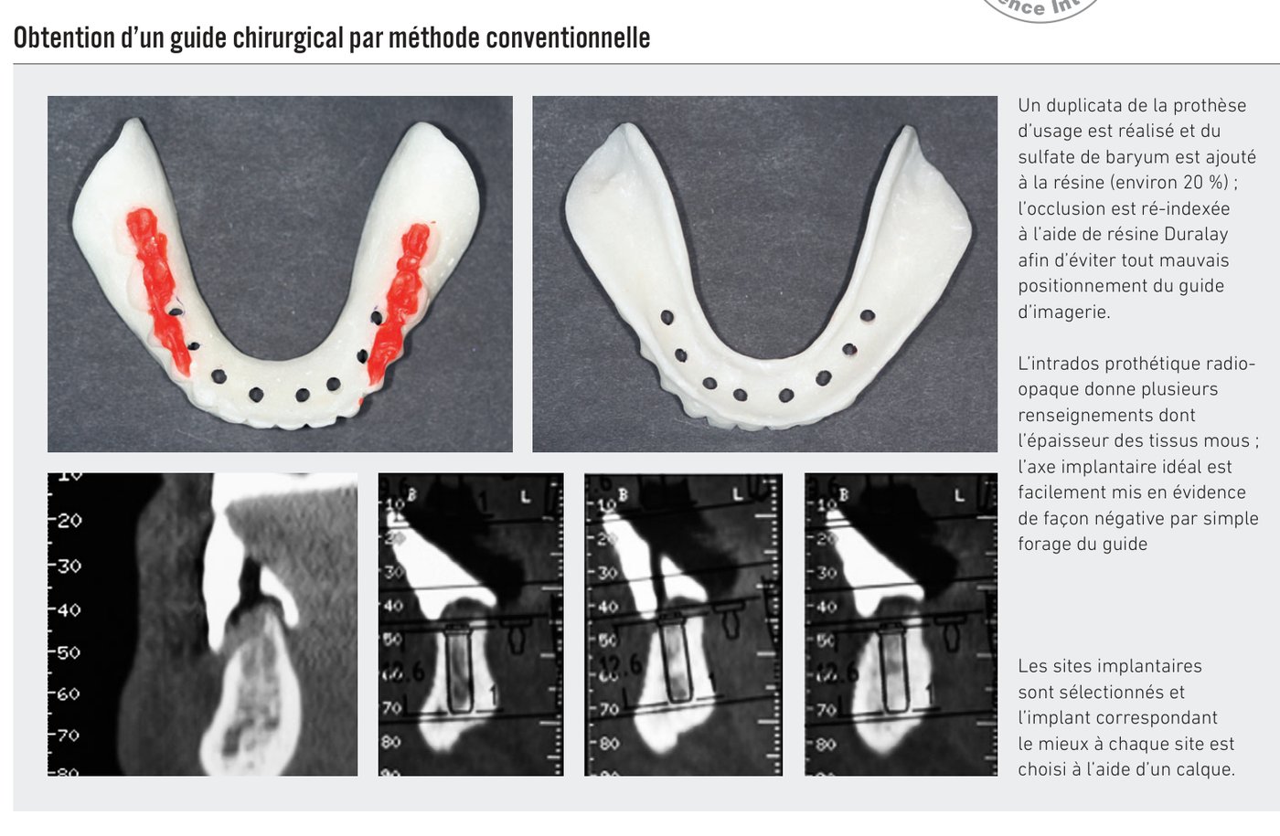 Obtention d'un guide chirurgical par méthode conventionnelle