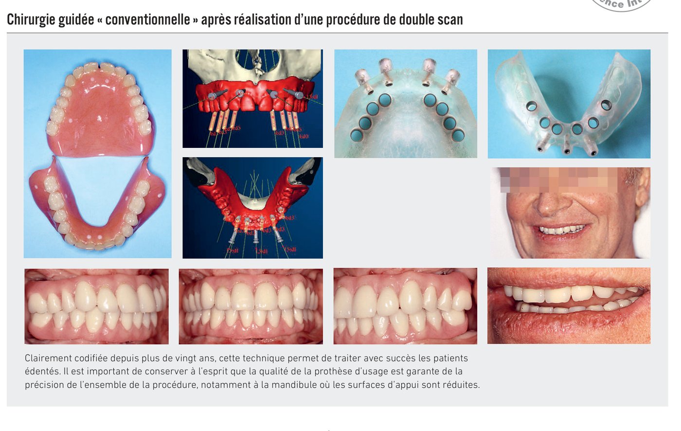 Chirurgie guidée conventionnelle après réalisation d'une procédure de double scan