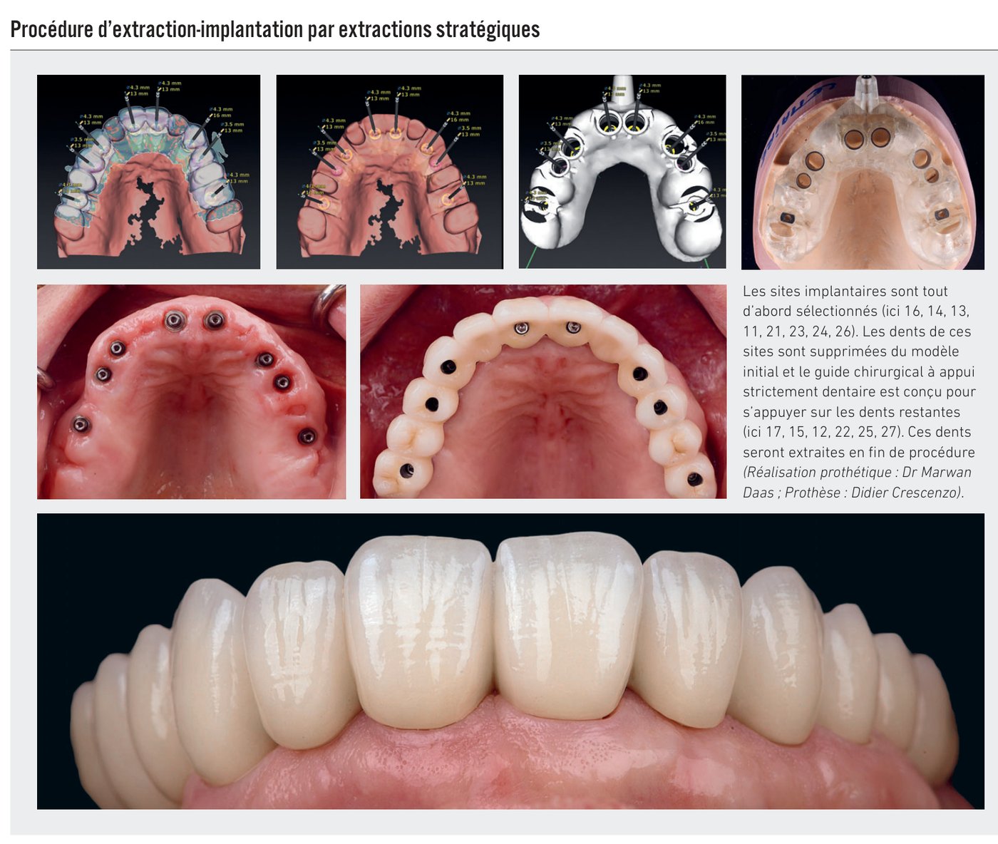 Procédure d'extraction-implantation par extractions stratégiques
