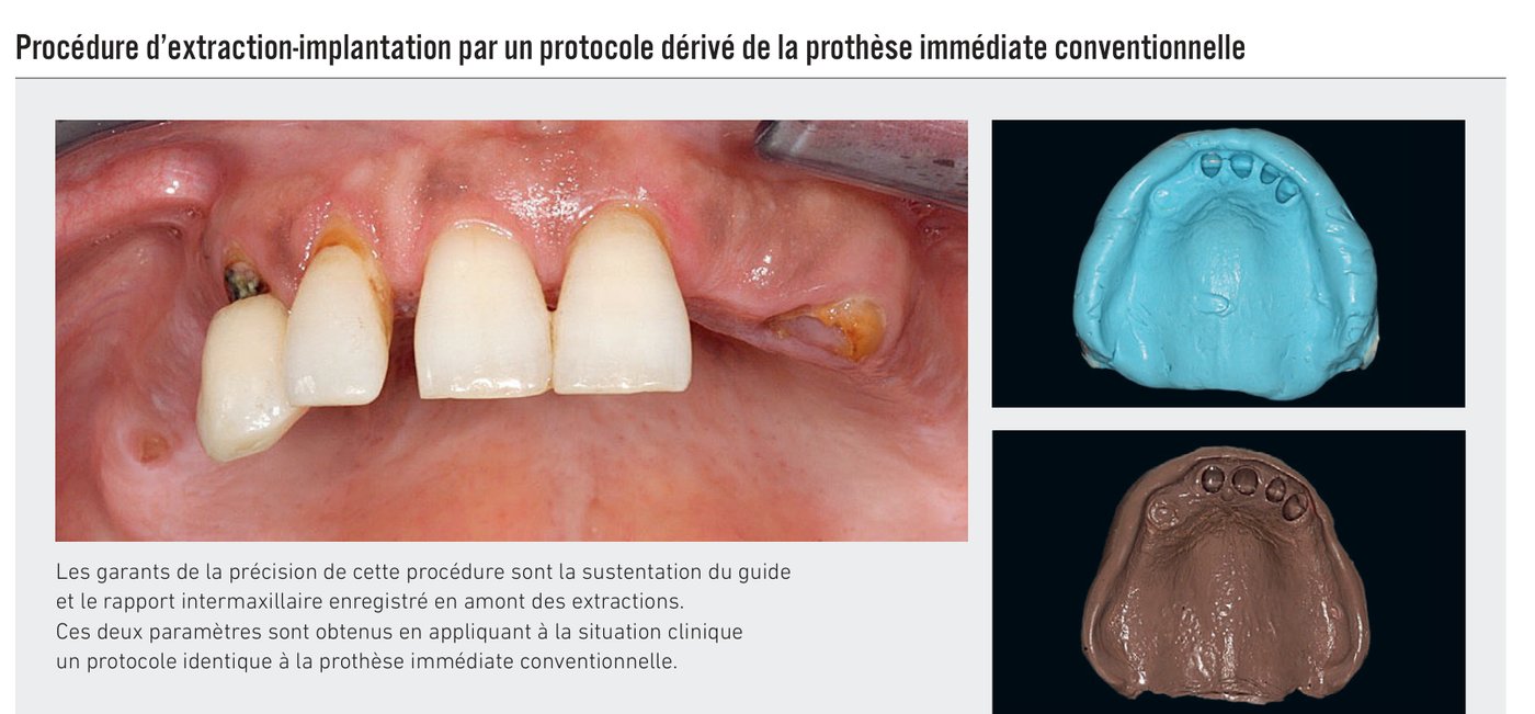 Procédure d'extraction-implantation par un protocole dérivé de la prothèse immédiate conventionnelle