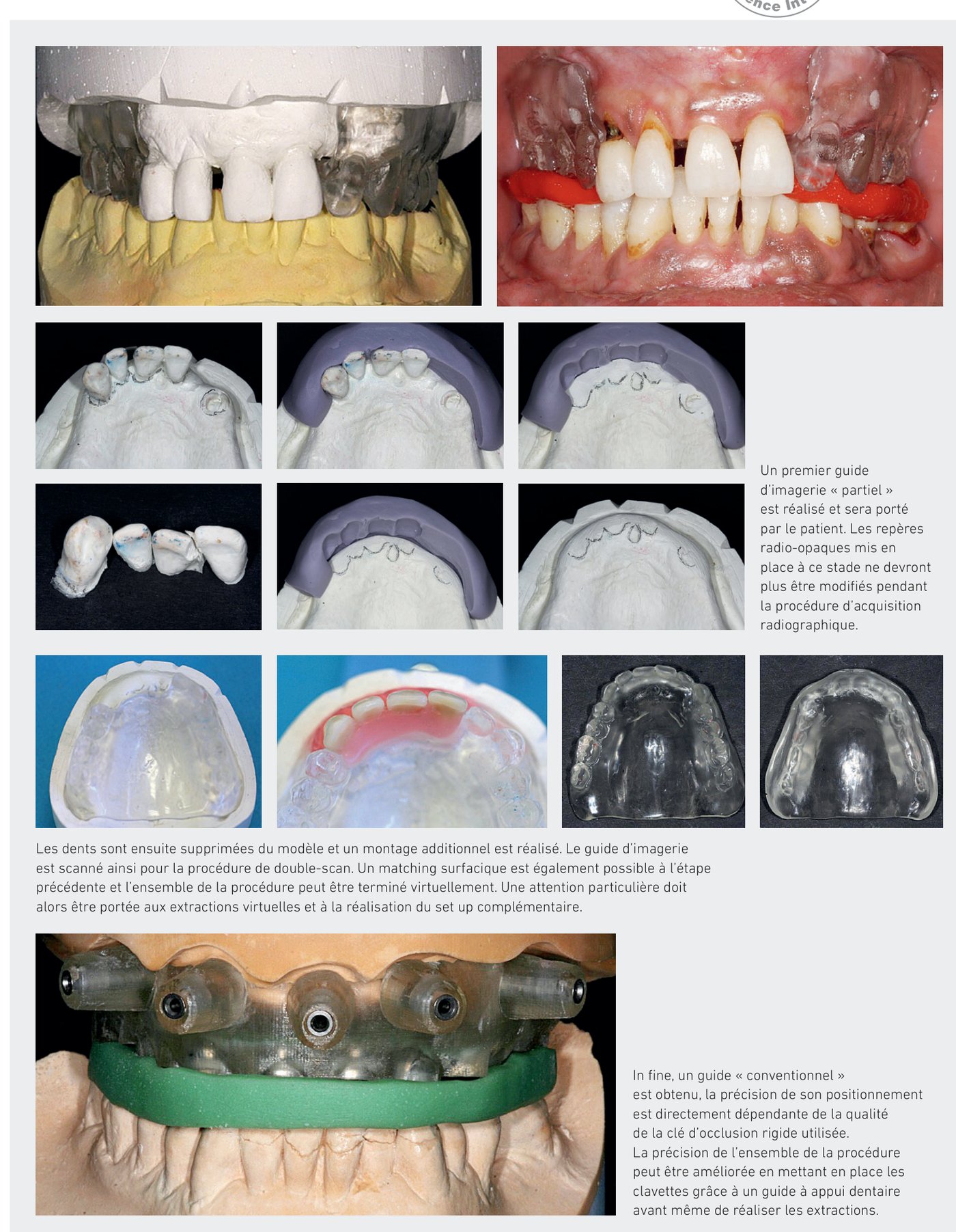 Étapes de la procédure d'extraction-implantation avec guide d'imagerie et montage additionnel