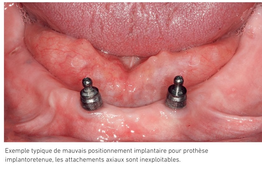Exemple typique de mauvais positionnement implantaire pour prothèse implantoretenue