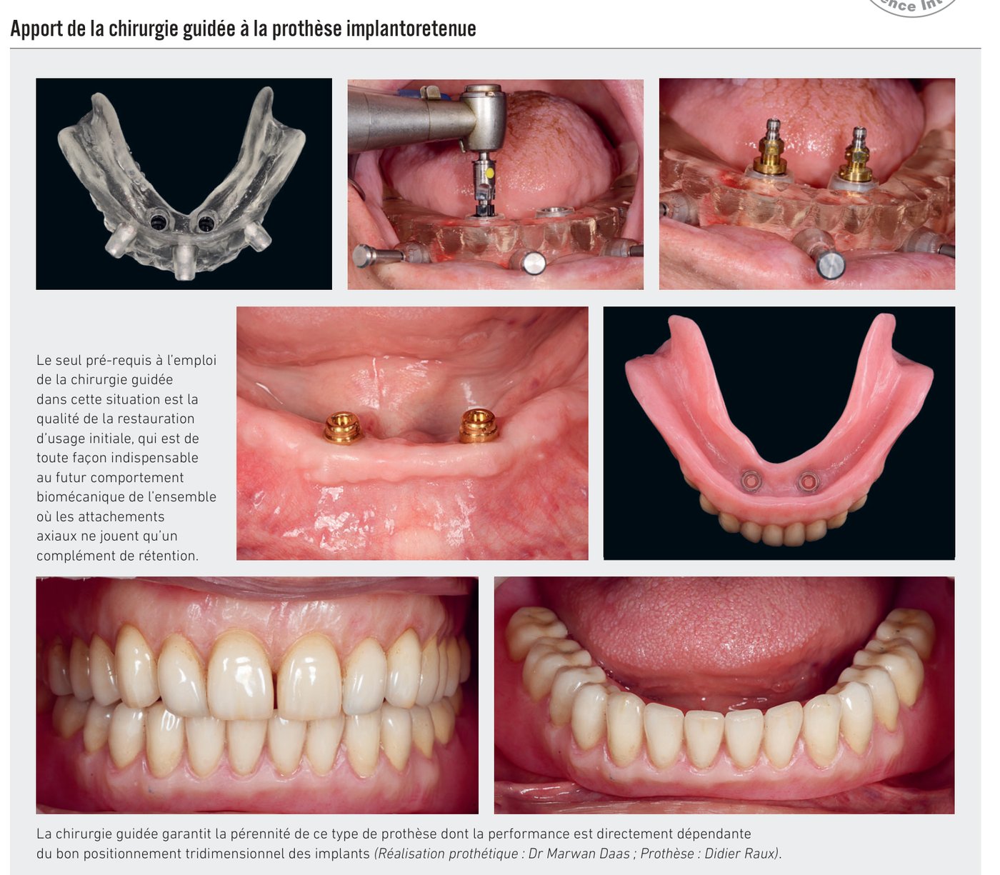 Apport de la chirurgie guidée à la prothèse implantoretenue