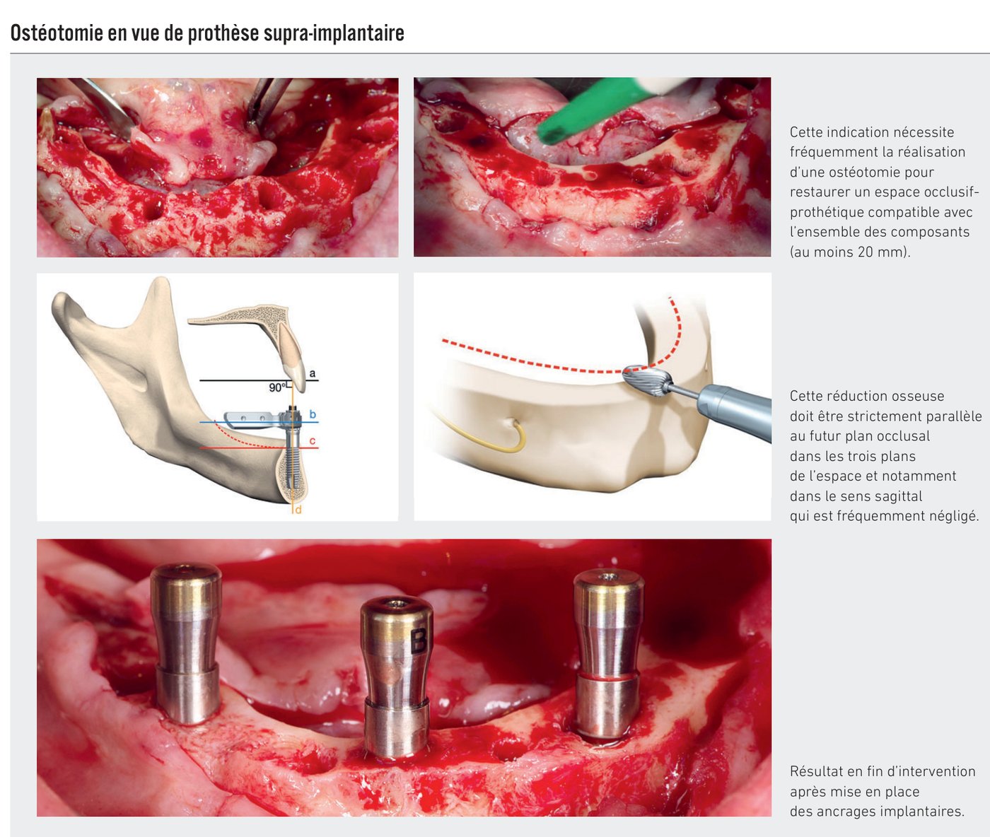 Ostéotomie en vue de prothèse supra-implantaire avec réduction osseuse parallèle au futur plan occlusal
