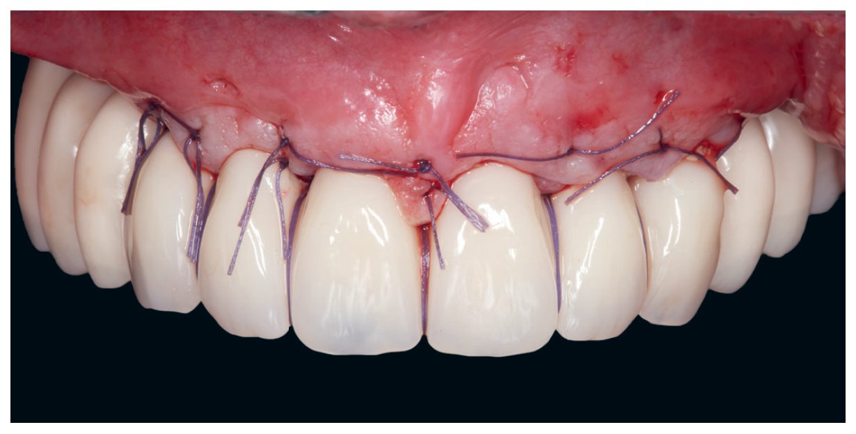 Photos cliniques illustrant des situations d'édentement complet et de passage à l'édentement