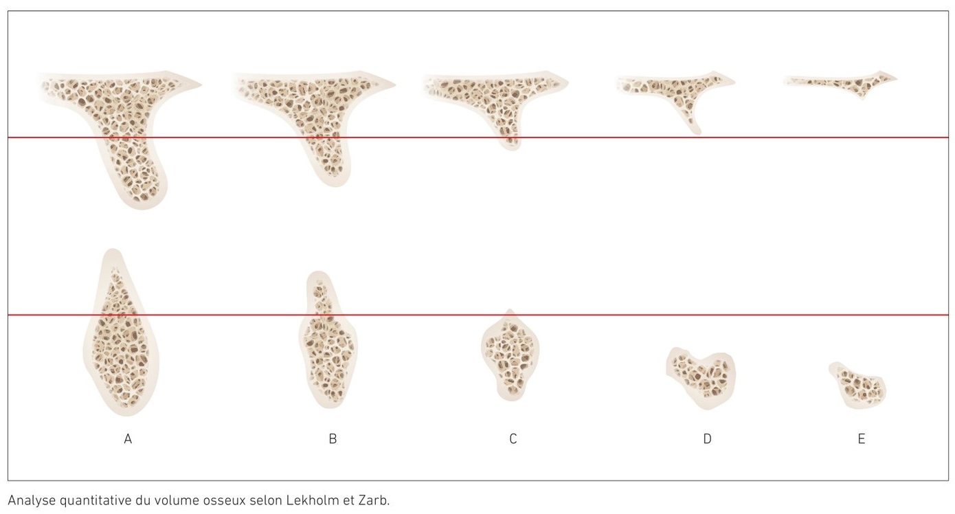 Analyse quantitative et qualitative du volume osseux selon la classification de Lekholm et Zarb