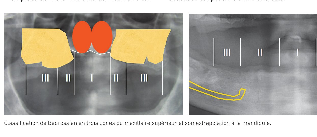 Classification de Bedrossian en trois zones du maxillaire supérieur et son extrapolation à la mandibule