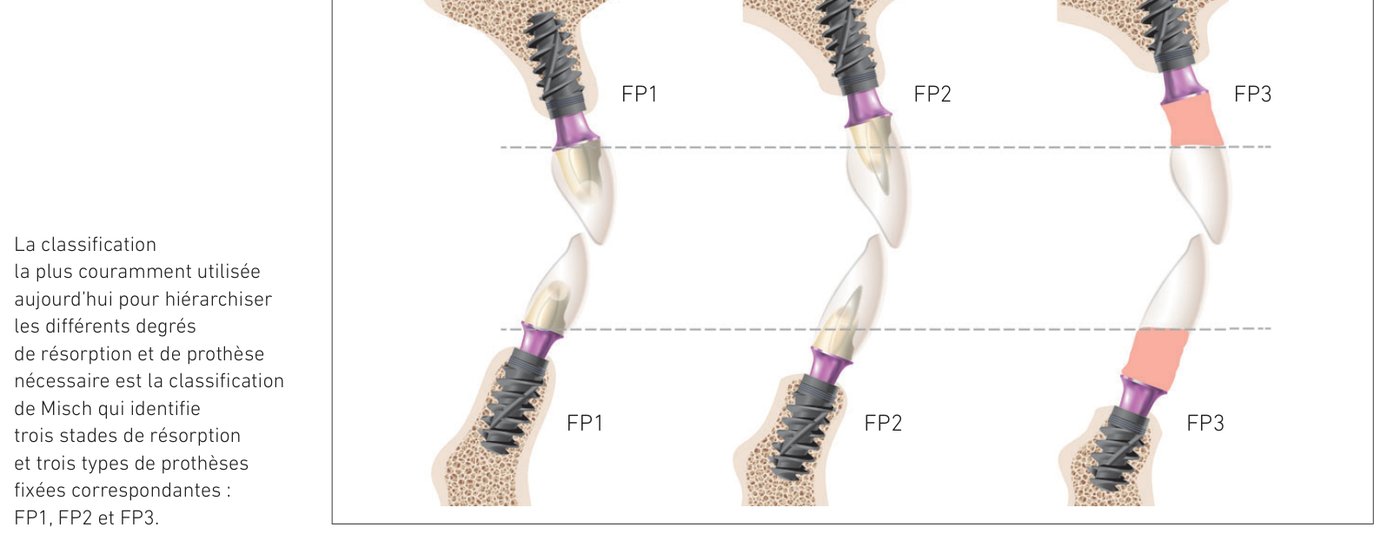 Classification de Misch : trois stades de résorption et trois types de prothèses fixées correspondantes FP1, FP2 et FP3